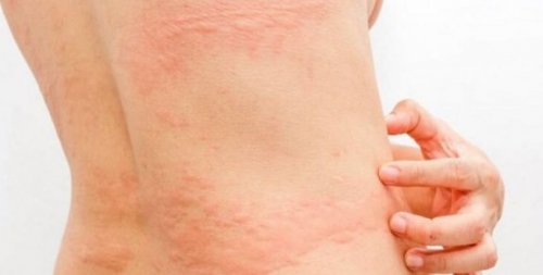 person med udslæt fra allergier på huden
