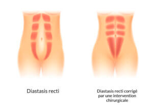 Le diastasis abdominal.