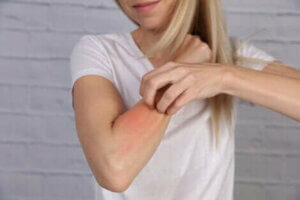 Une femme ayant une allergie cutanée.