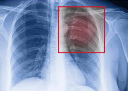 Radiographie des fractures de stress des côtes.