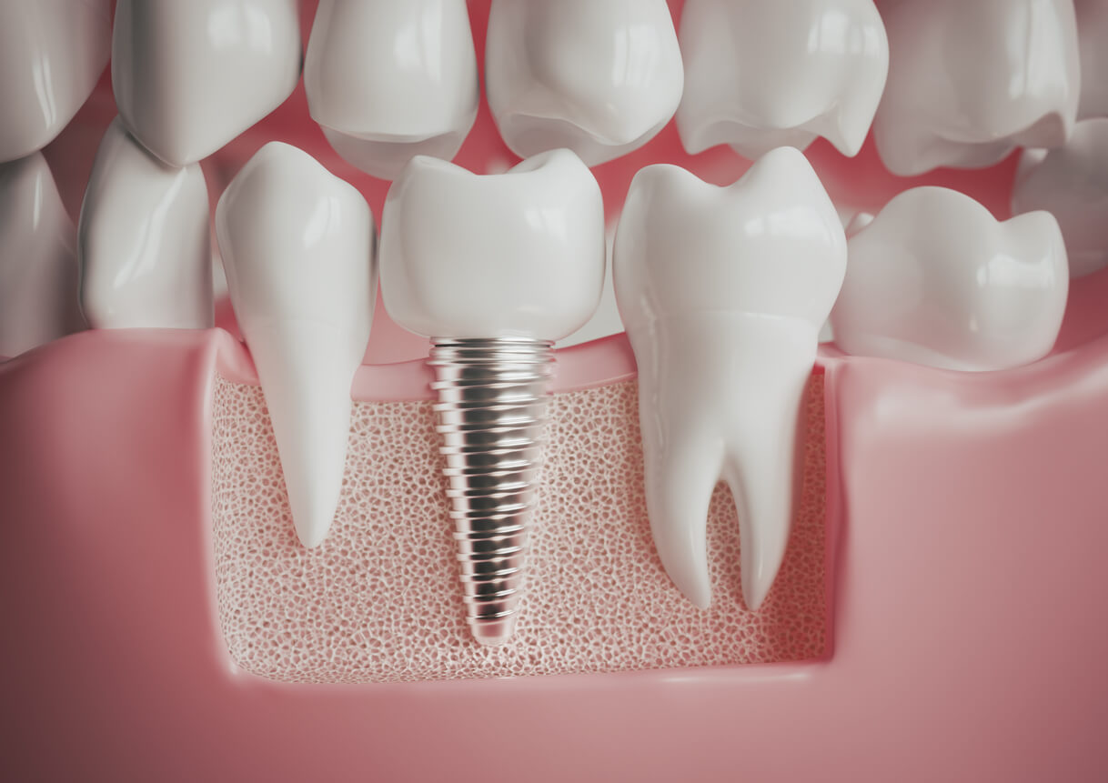 modélisation d'un implant dentaire