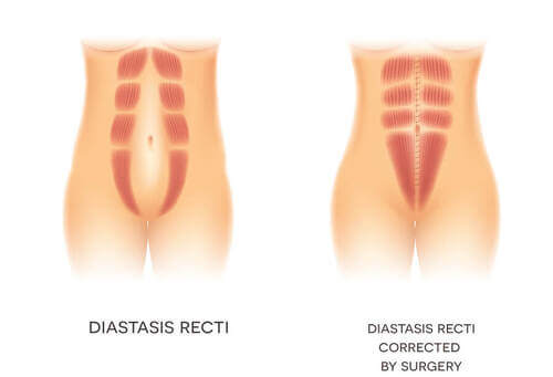 Grave caso di diastasi addominale corretta chirurgicamente.