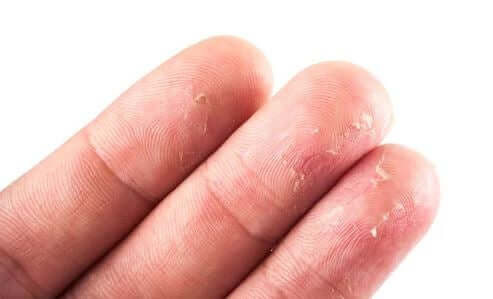 Złuszczone palce skóry