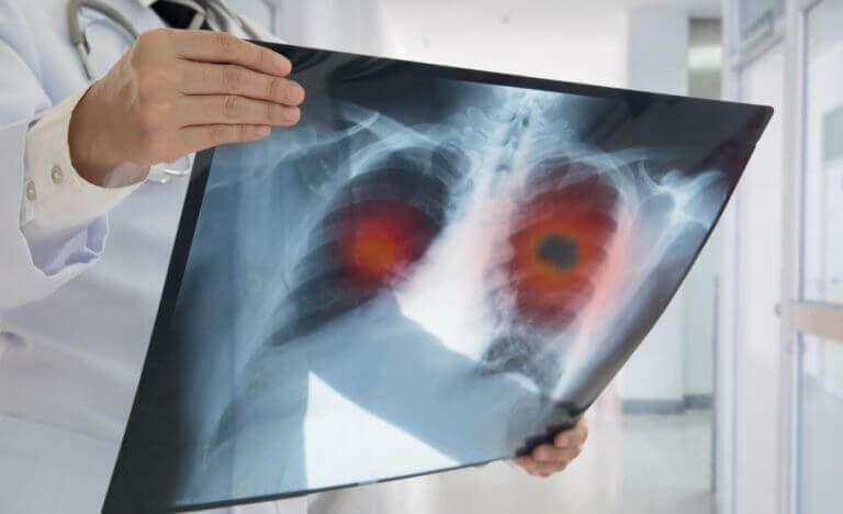 Médico segurando raio x do pulmão