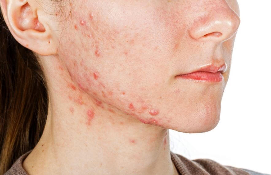Garota com acne