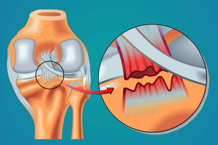 Tipos de lesões dos ligamentos do joelho.