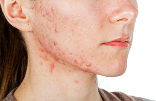 Woman's face with cystic acne