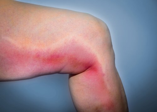 Prevent blood clots with exercise