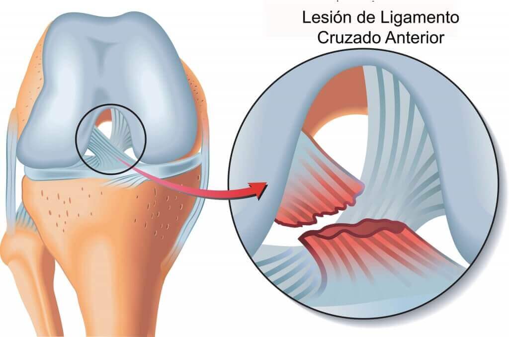 Knee ligament