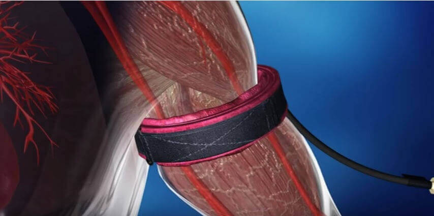 occlusion training