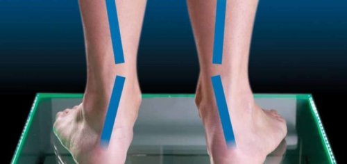 Special footwear can help fix pronation.
