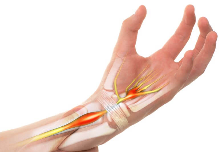 carpal tunnel syndrome wrist
