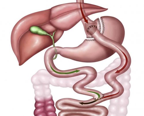 There are three types of bariatric techniques.