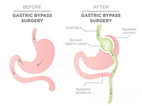 Gastric bypass is one of the most popular techniques.