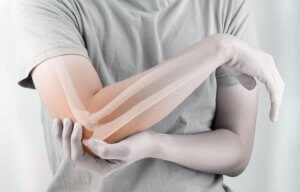 A woman with elbow joint pain.