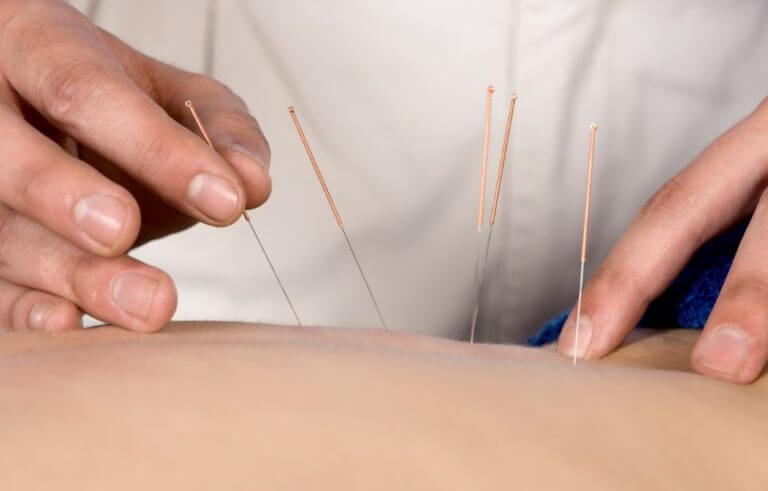 A physical therapist using the dry needling technique on the back of a patient