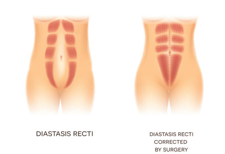 An illustration of diastasis recti corrected by surgery