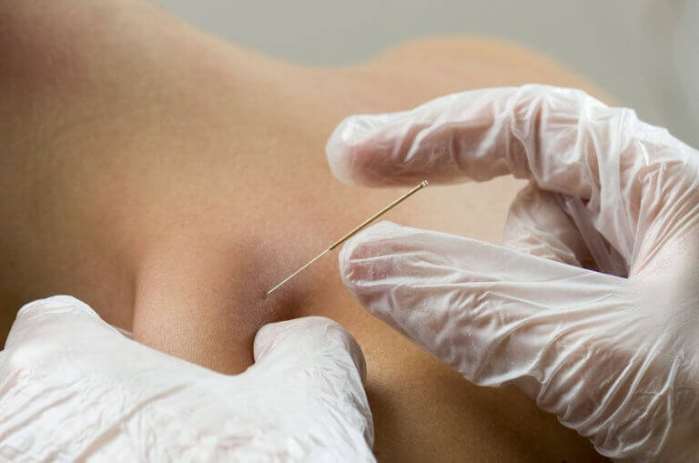 Inserting an acupuncture needle in the back of a patient