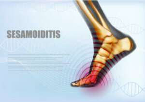 A foot with sesamoiditis pain.