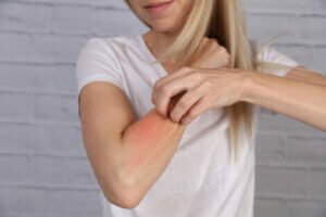 A woman with a rash on her arm.