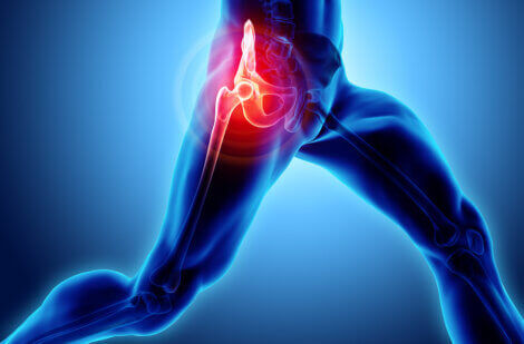Hip pain: Trochanteric bursitis.
