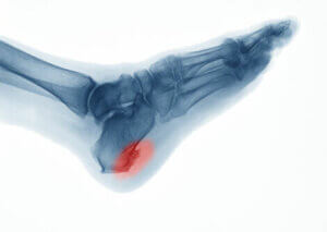 An x-ray of heel spurs.