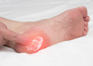 Foot Pain Caused by Heel Spurs